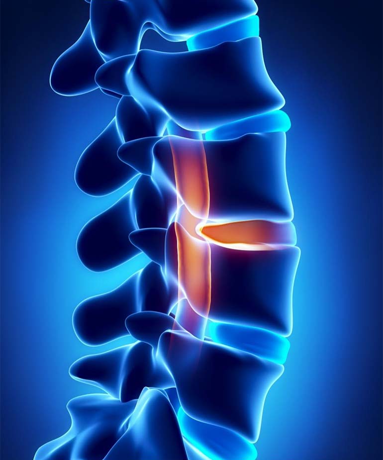 New York City Spinal Cord Injury Lawyers